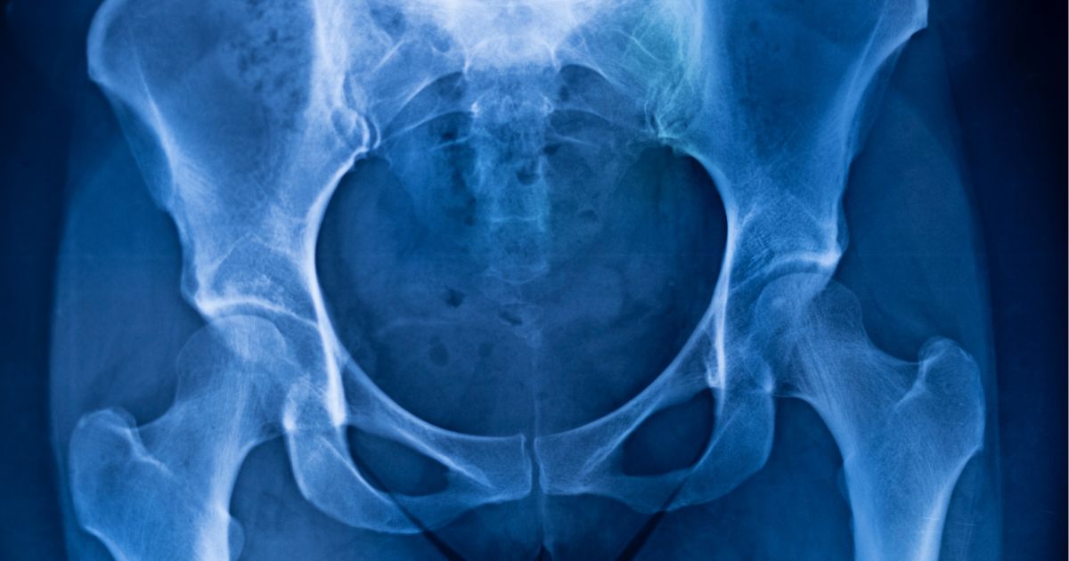 Picture of a pelvic injury scan